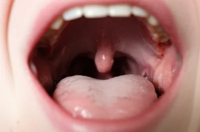 Illustration uvulae - Image 1