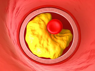 Illustration blockage - Image 1