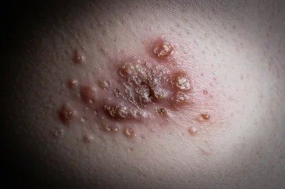 Illustration pox - Image 1