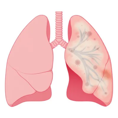 Illustration pneumonia