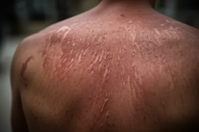 Illustration excoriate