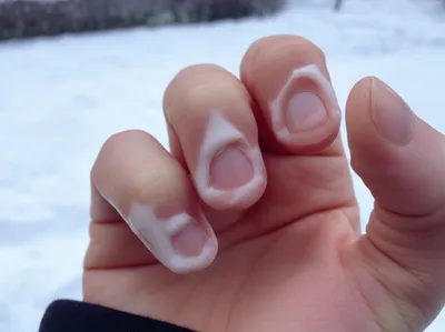 Illustration frostbite - Image 1