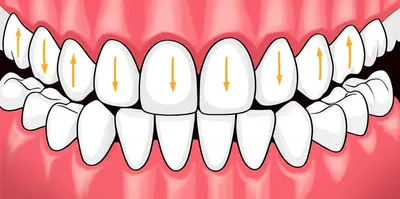 Illustration occlusion - Image 1