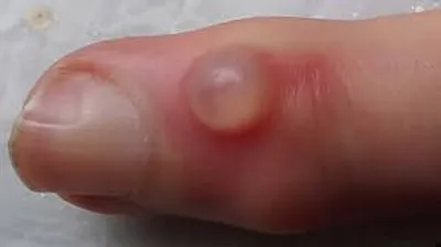 Illustration cyst - Image 3