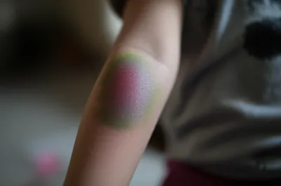 Illustration bruises - Image 1