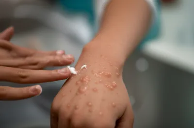 Illustration blisters - Image 1