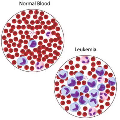 Illustration leukemia - Image 2