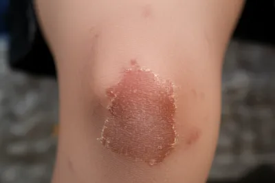 Illustration scabs - Image 1