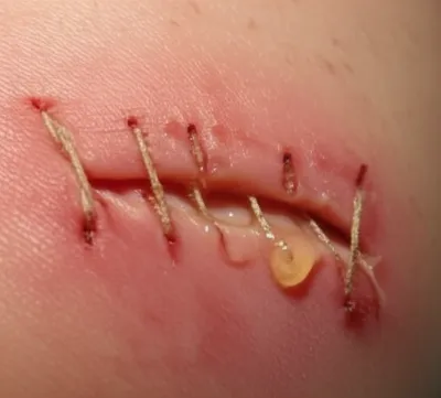 Illustration dehiscence - Image 1