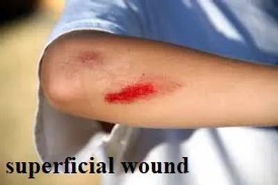 Illustration superficial - Image 2