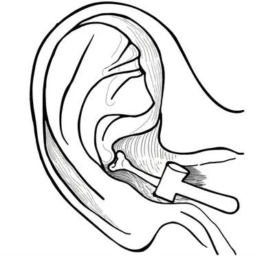 Illustration malleus - Image 1