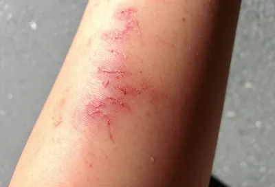 Illustration excoriated