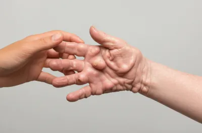 Illustration rheumatism - Image 1