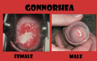 Illustration gonorrhea - Image 2