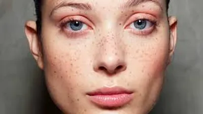 Illustration freckled - Image 2