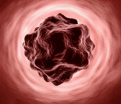 Illustration thrombus