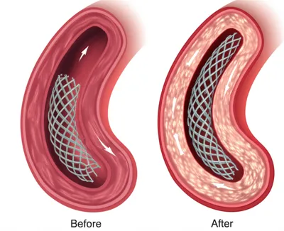 Illustration stent - Image 1