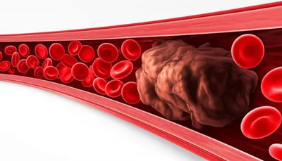 Illustration thrombosis