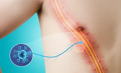 Illustration shingles