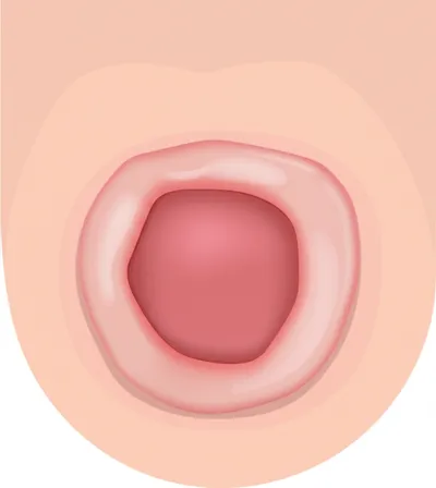 Illustration chancre