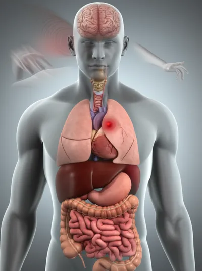 Illustration apoplexy - Image 1