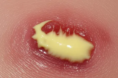 Illustration pyogenic