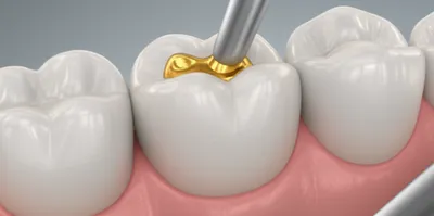 Illustration inlays - Image 1