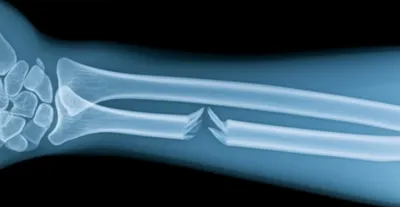 Illustration fracture - Image 1