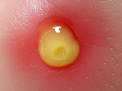 Illustration purulent - Image 1