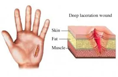 Illustration laceration - Image 2