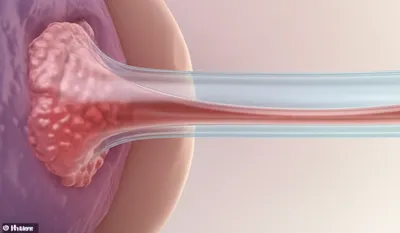 Illustration shunt - Image 1