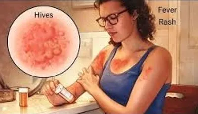 Illustration antihistamine - Image 2