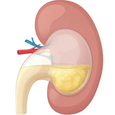 Illustration cyst - Image 1