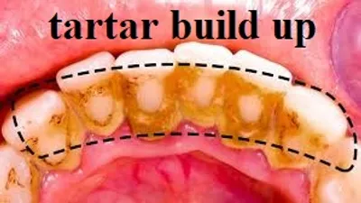 Illustration buildup - Image 2