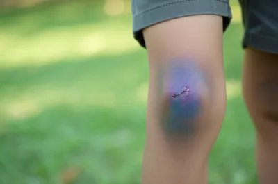 Illustration contusion - Image 1