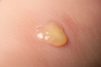 Illustration pus - Image 1