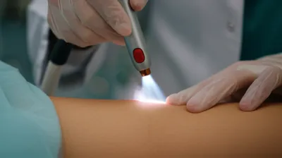 Illustration cauterize - Image 1