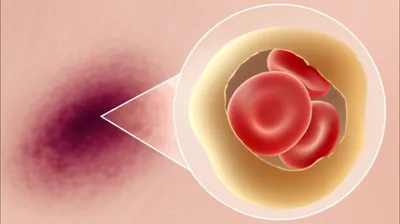 Illustration bilirubin